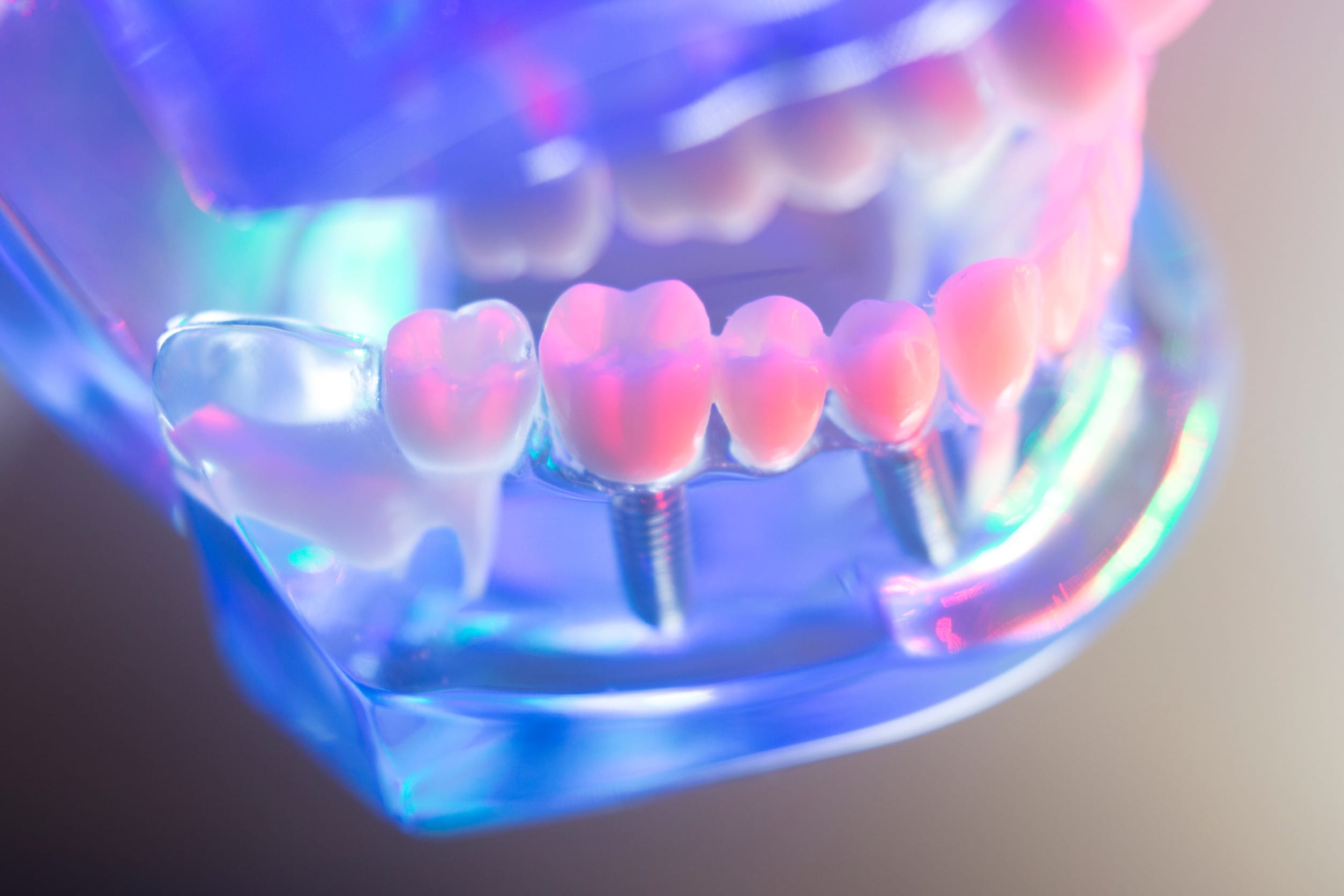 Impianto dentale come funziona